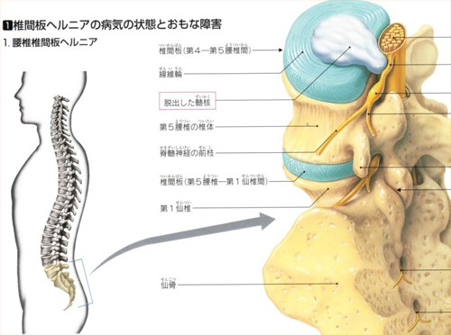 手術 椎間板 ヘルニア